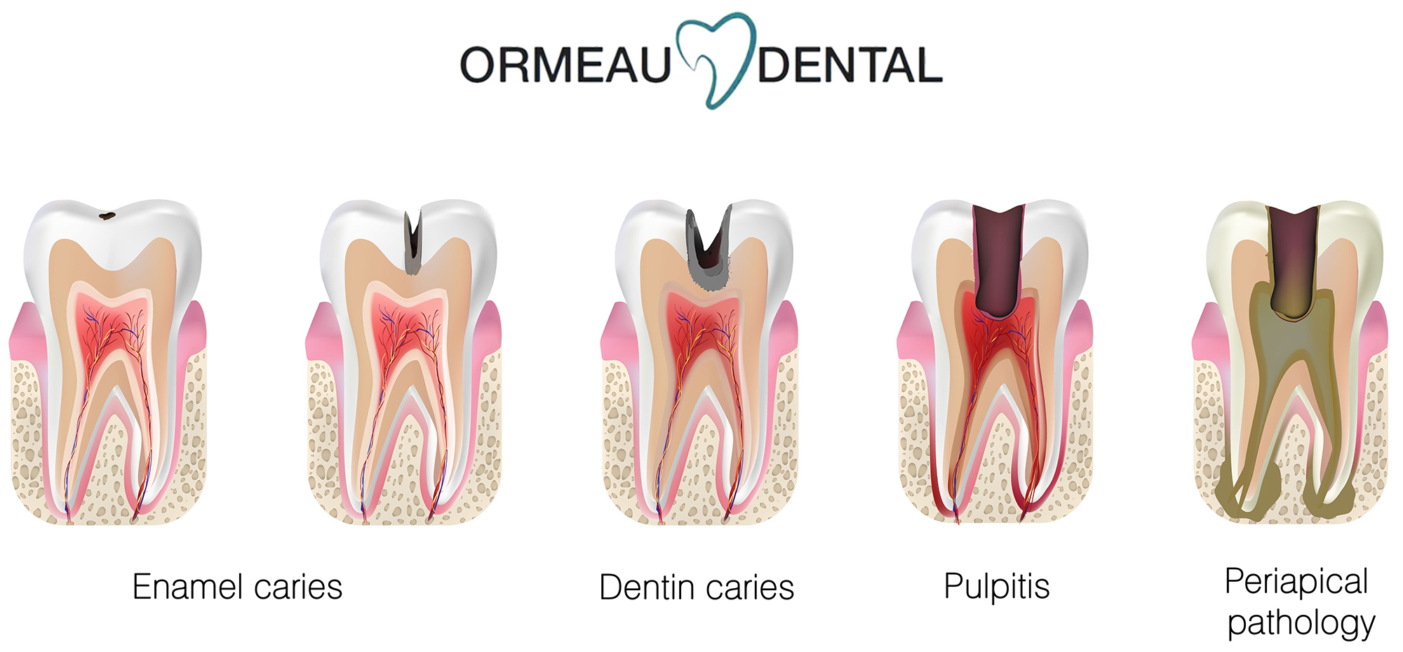 Comprehensive Guide to Tooth Decay