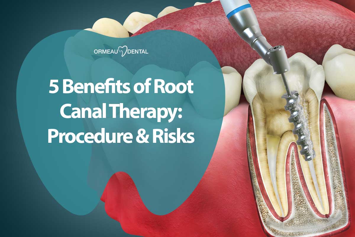5 Benefits of Root Canal Therapy: Procedure and Risks