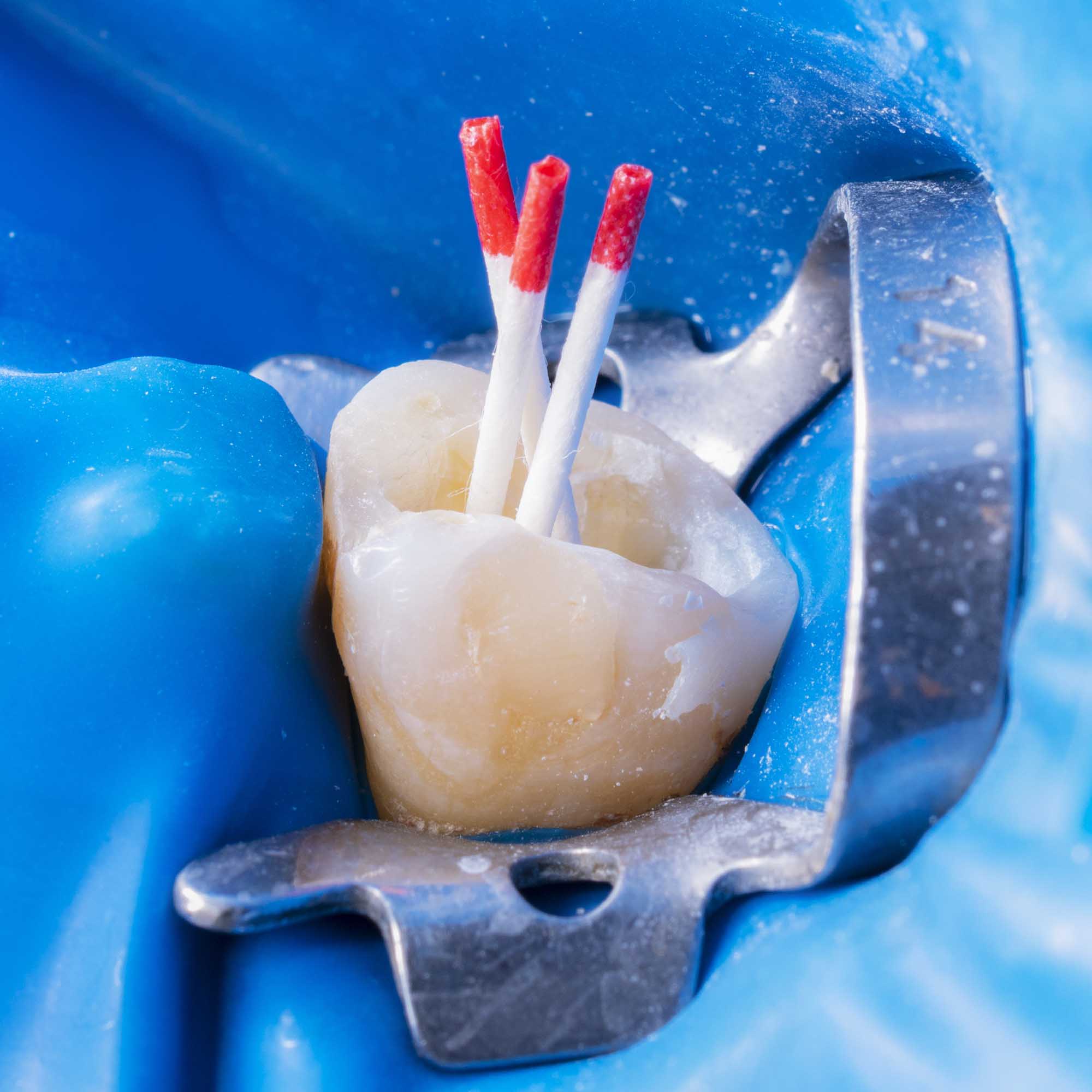 Procedure of Root Canal Therapy - Ormeau Dentist Gold Coast