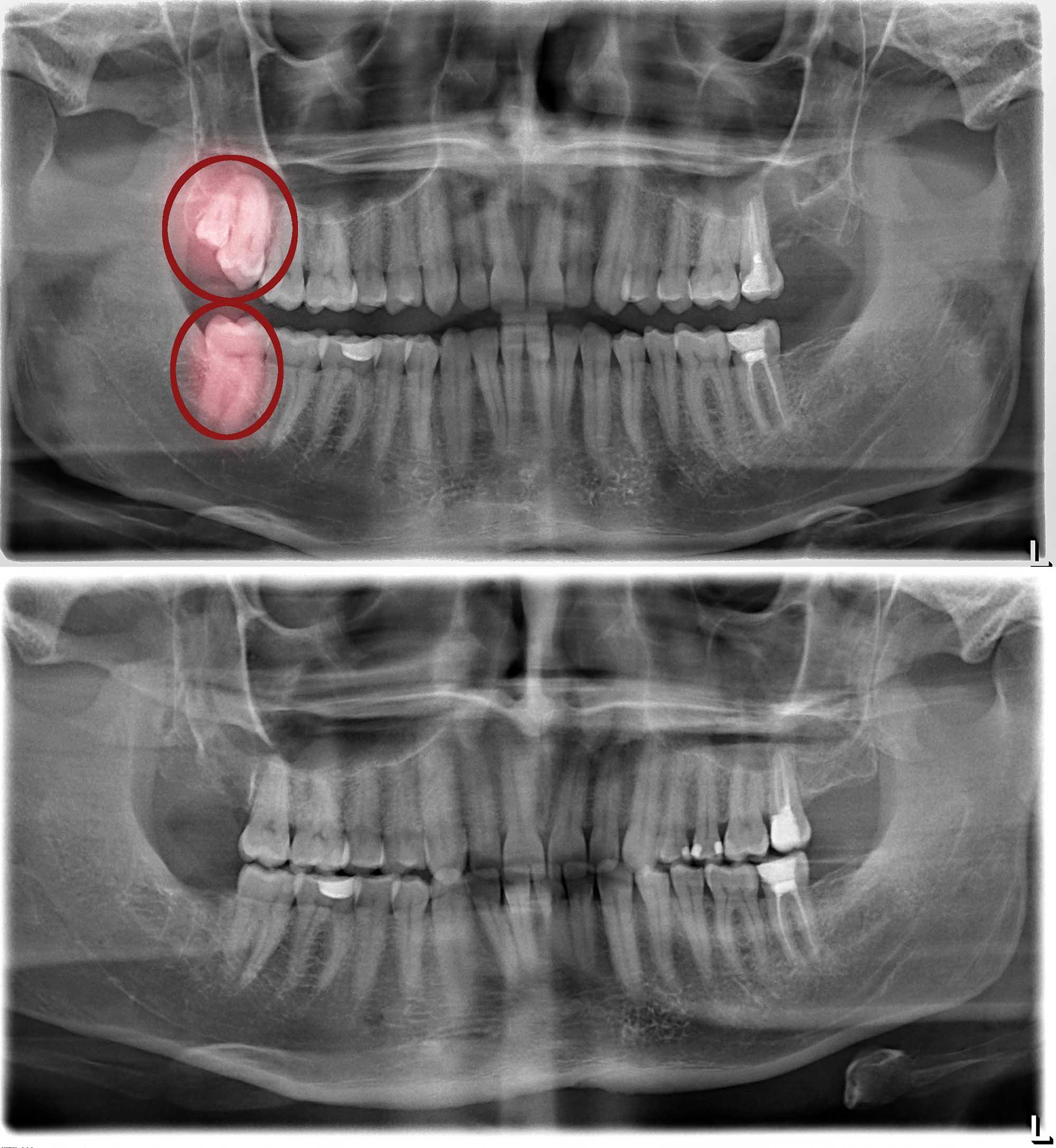 Trusted Gold Coast Dentists For Wisdom Tooth Extractions