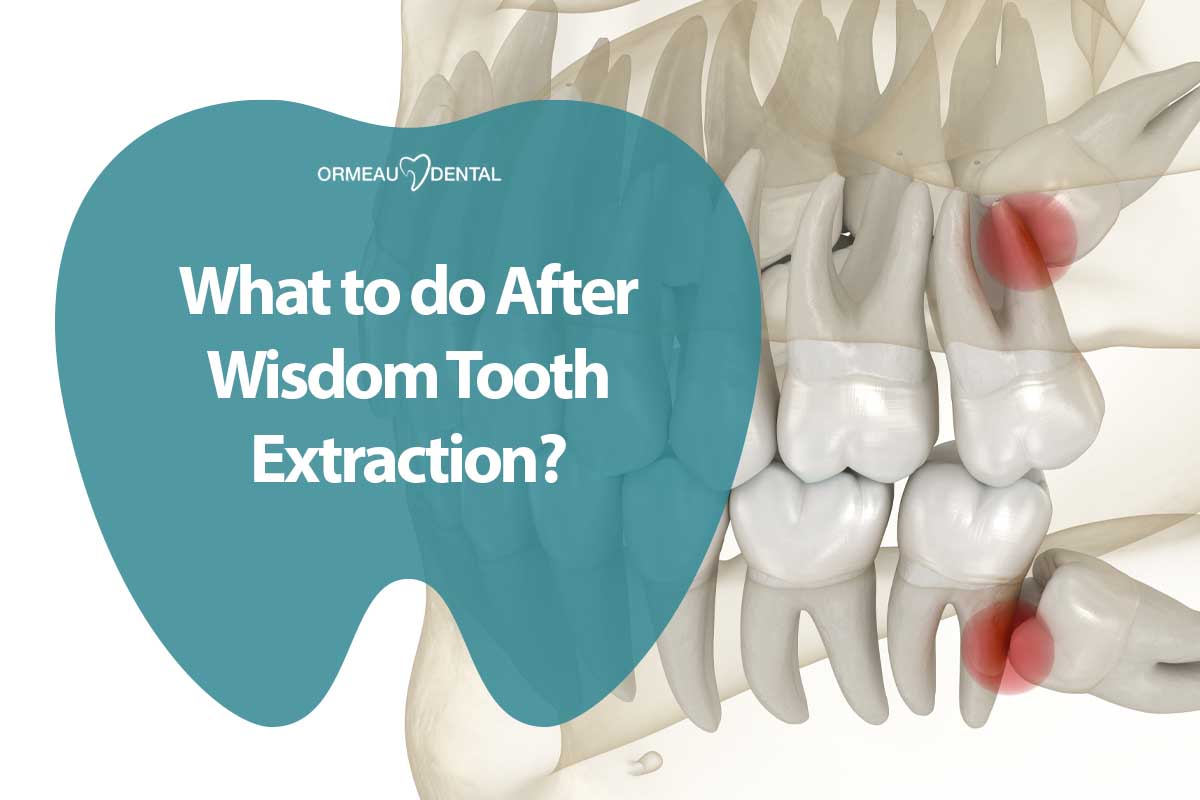 What to do After Wisdom Tooth Extraction?