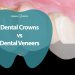 Dental Crowns vs Dental Veneers