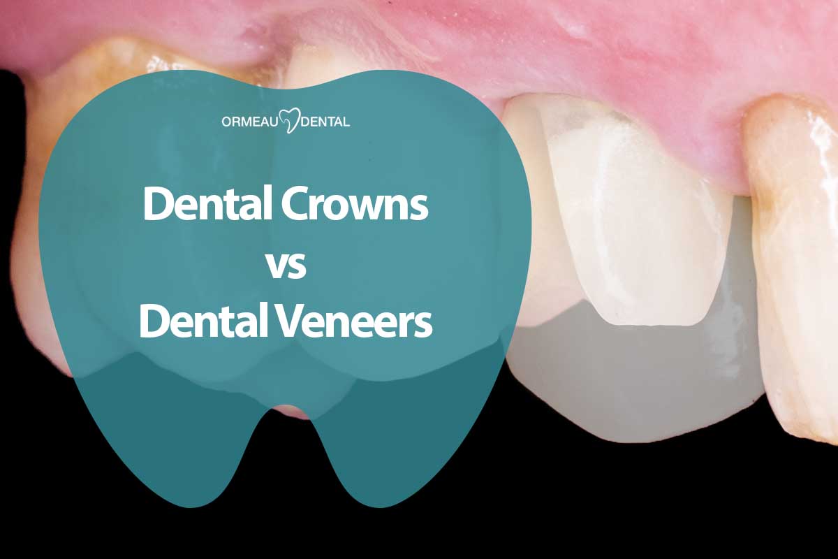 Dental Crowns vs Dental Veneers: Understanding the Recommendations