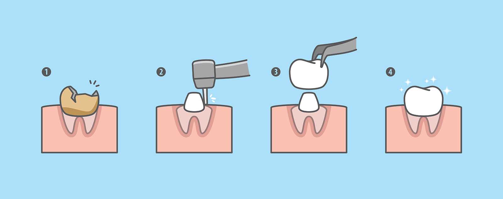 Understanding Dental Crowns - Ormeau Dental Gold Coast