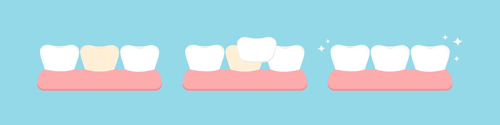 Understanding Porcelain Veneers - Ormeau Dental Gold Coast