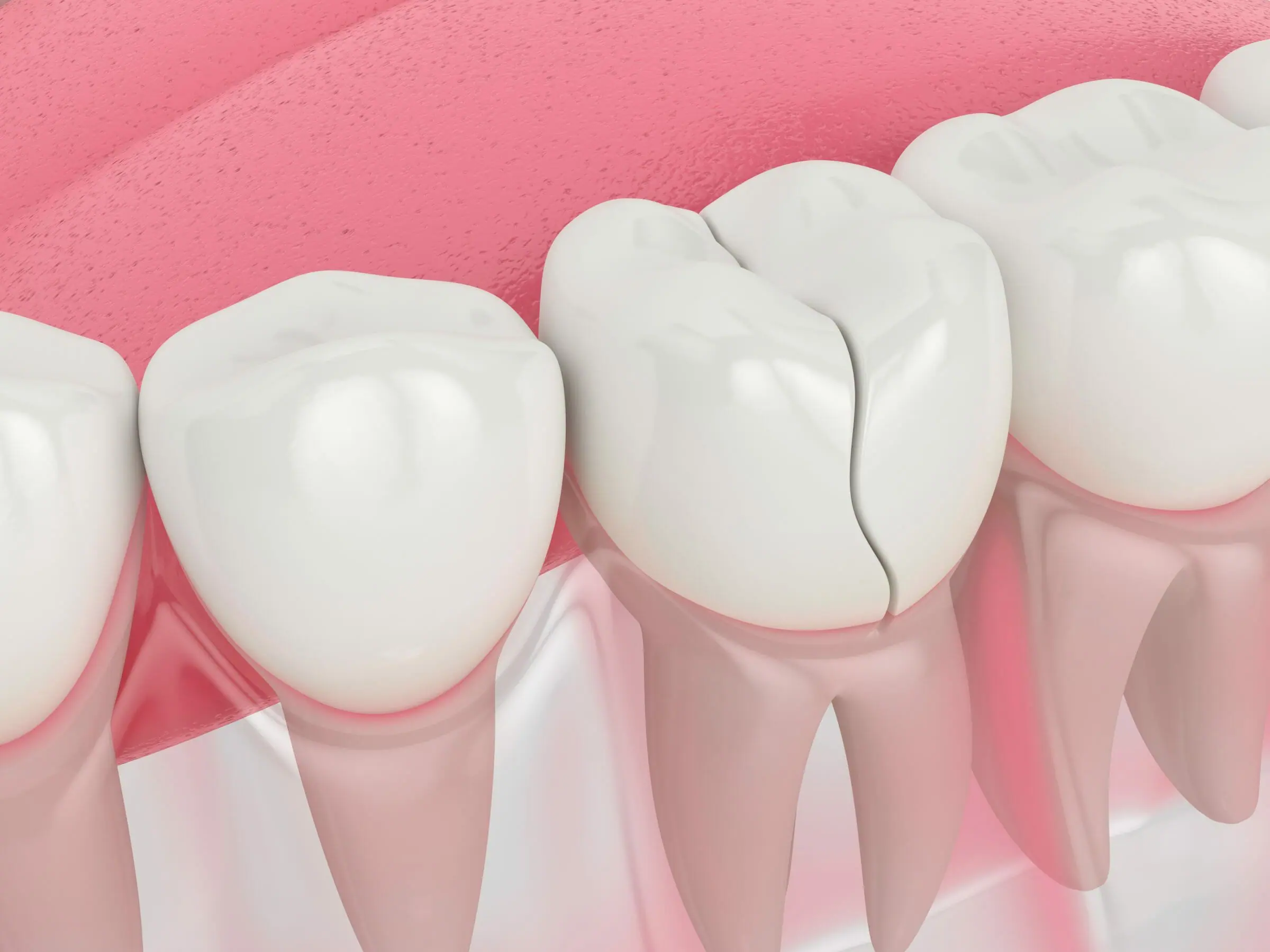 Cracked Tooth Causing Tooth Sensitivity
