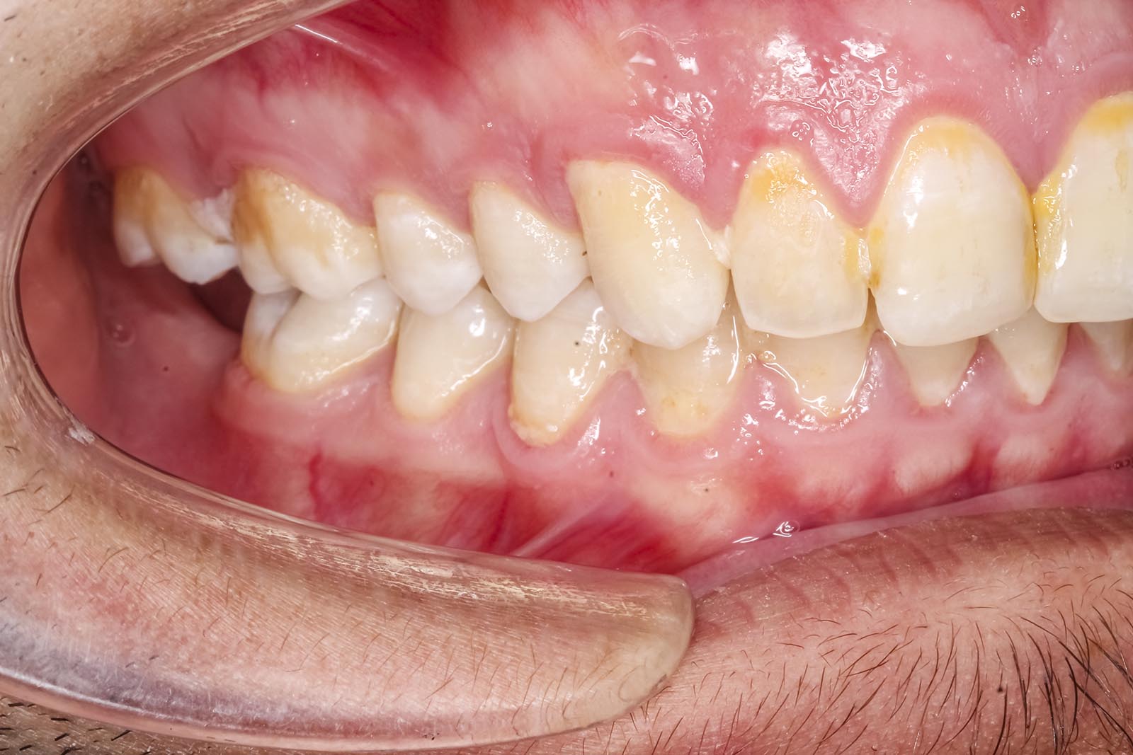 North Dentist Gold Coast - Enamel Erosion Ormeau Dental