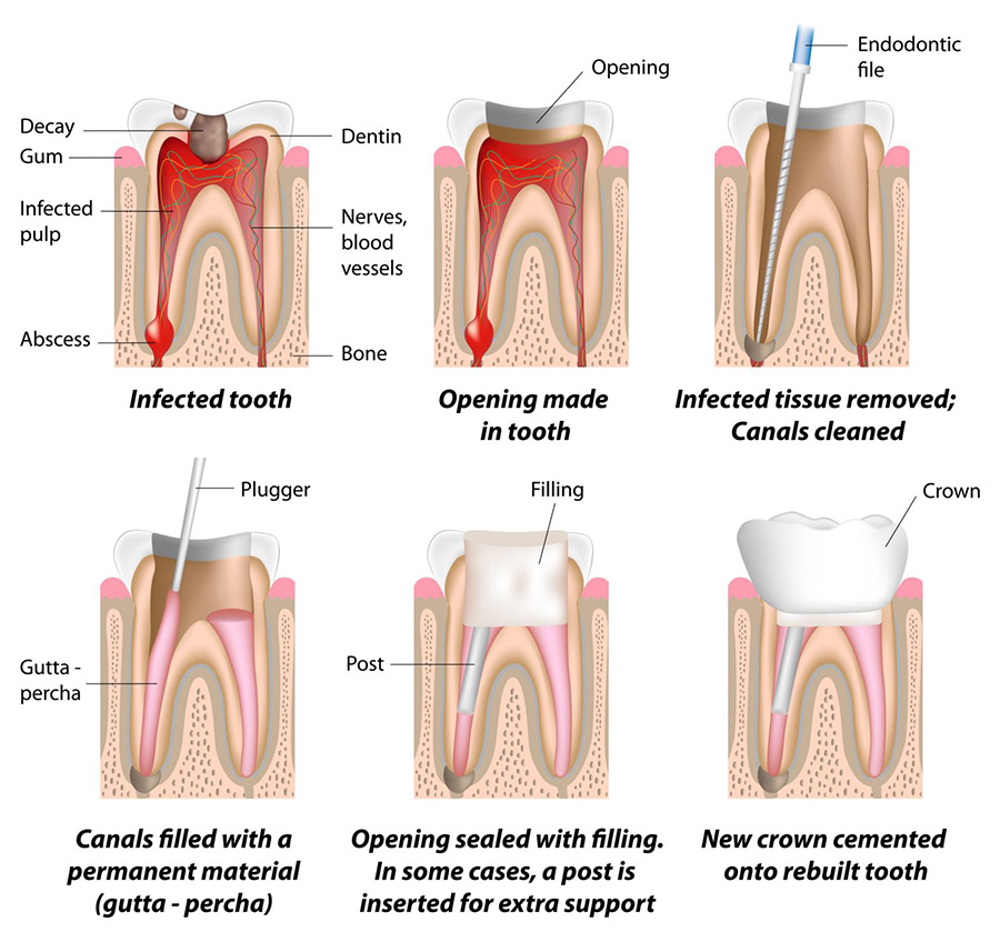 Ormeau Dentist Gold Coast - Root Canal Treatment 