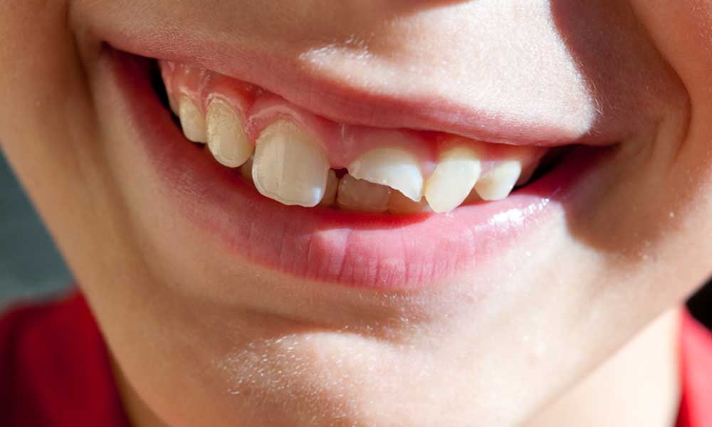 Common Causes of a Broken Tooth