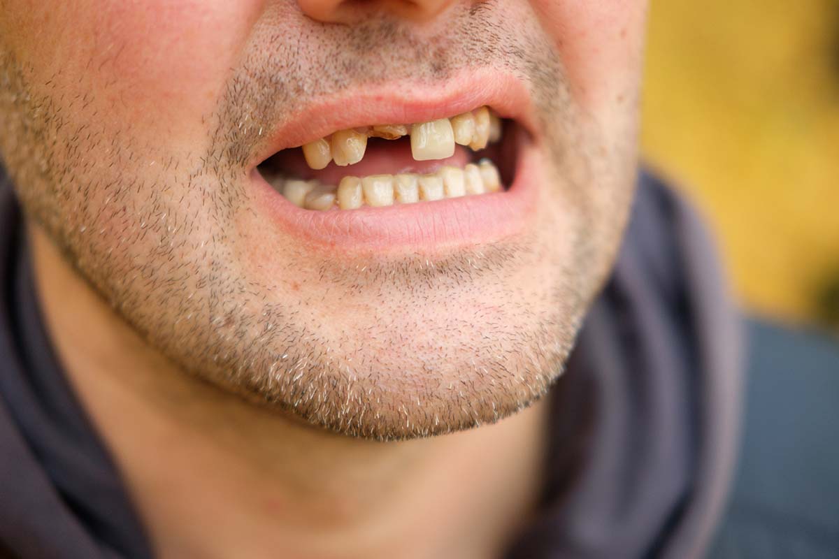 Fix Tooth Loss - Dentist Ormeau