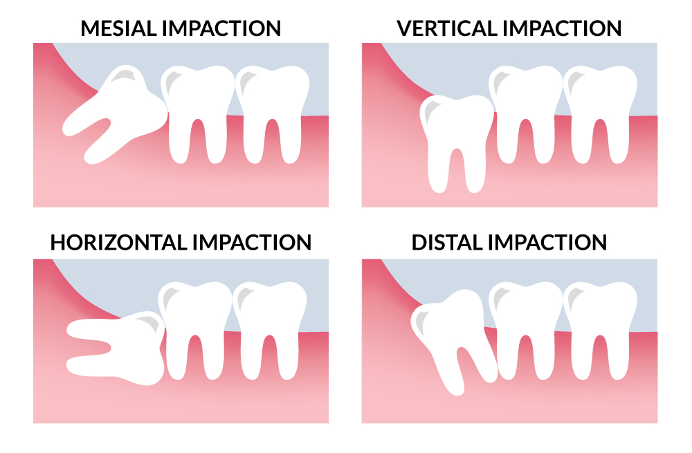Toothache from Impacted Wisdom Teeth - Ormeau Dentist Near Me