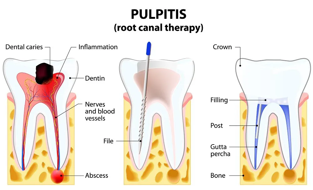 Toothpain Treatment Root Canal Therapy Ormeau Dentist Gold Coast
