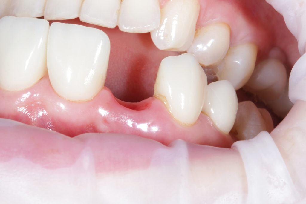 Risk Factors and Complications from Tooth Loss