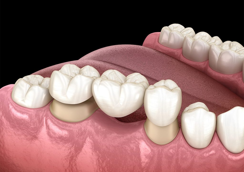 Tooth Loss Replacement Options