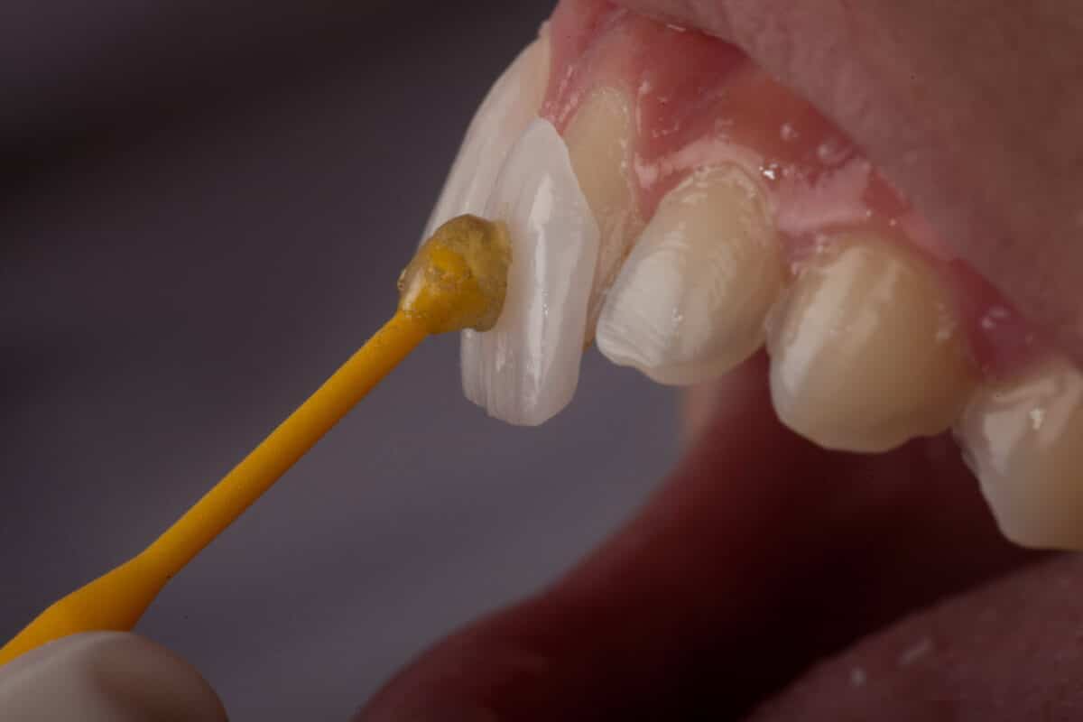 porcelain veneers for tooth staining 